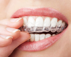 hand holding clear teeth aligners in mouth, Kent, WA Invisalign treatment